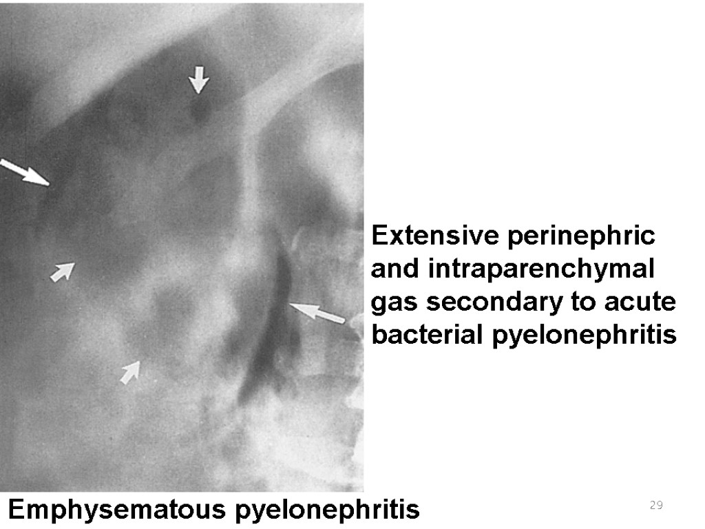 29 Extensive perinephric and intraparenchymal gas secondary to acute bacterial pyelonephritis Emphysematous pyelonephritis